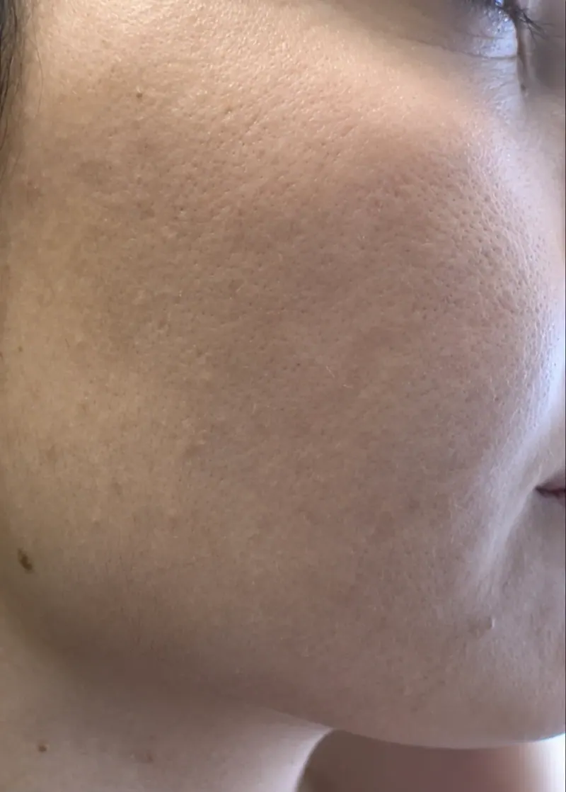 Acne after treatment