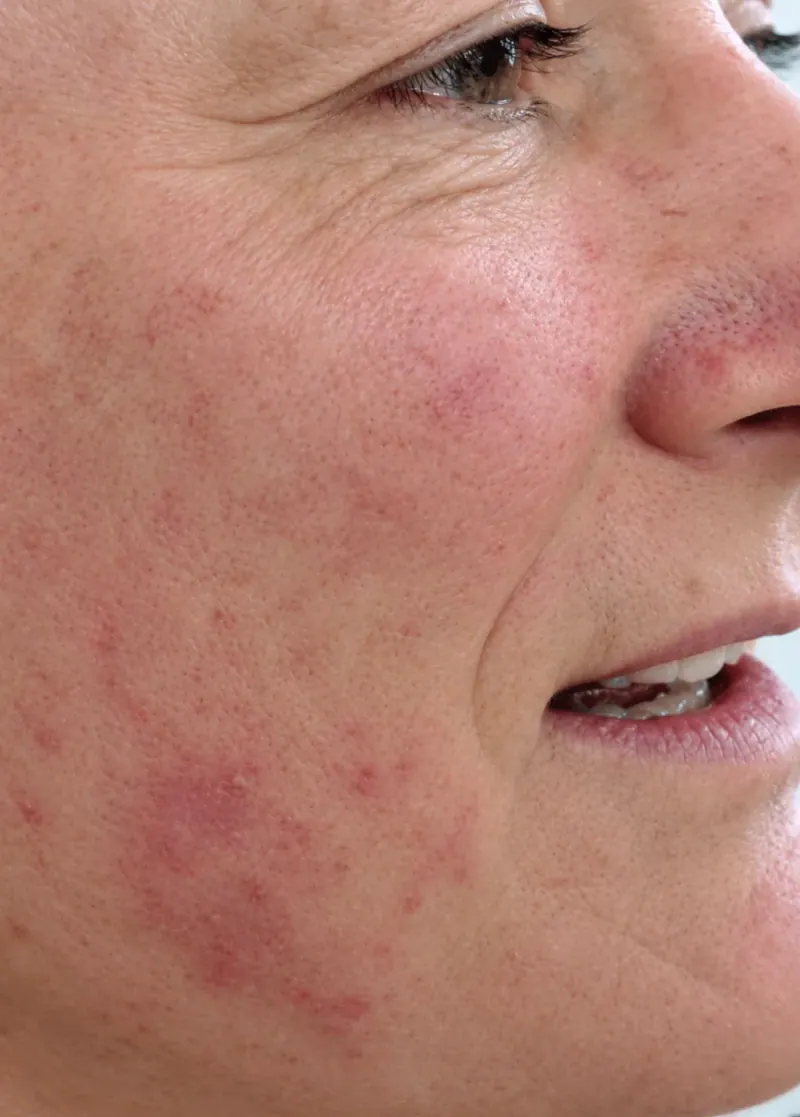 Fine Lines & Wrinkles before treatment