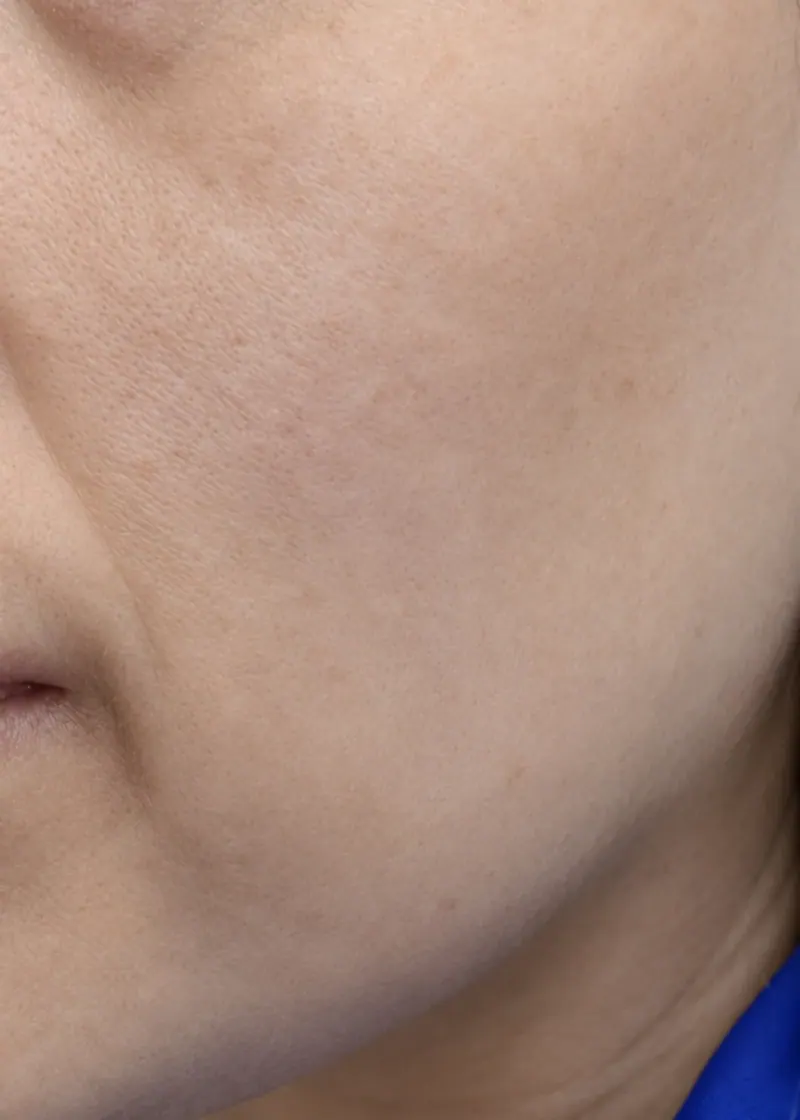 Melasma & Hyperpigmentation after treatment