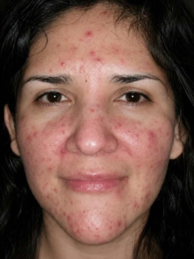 Rosacea before treatment